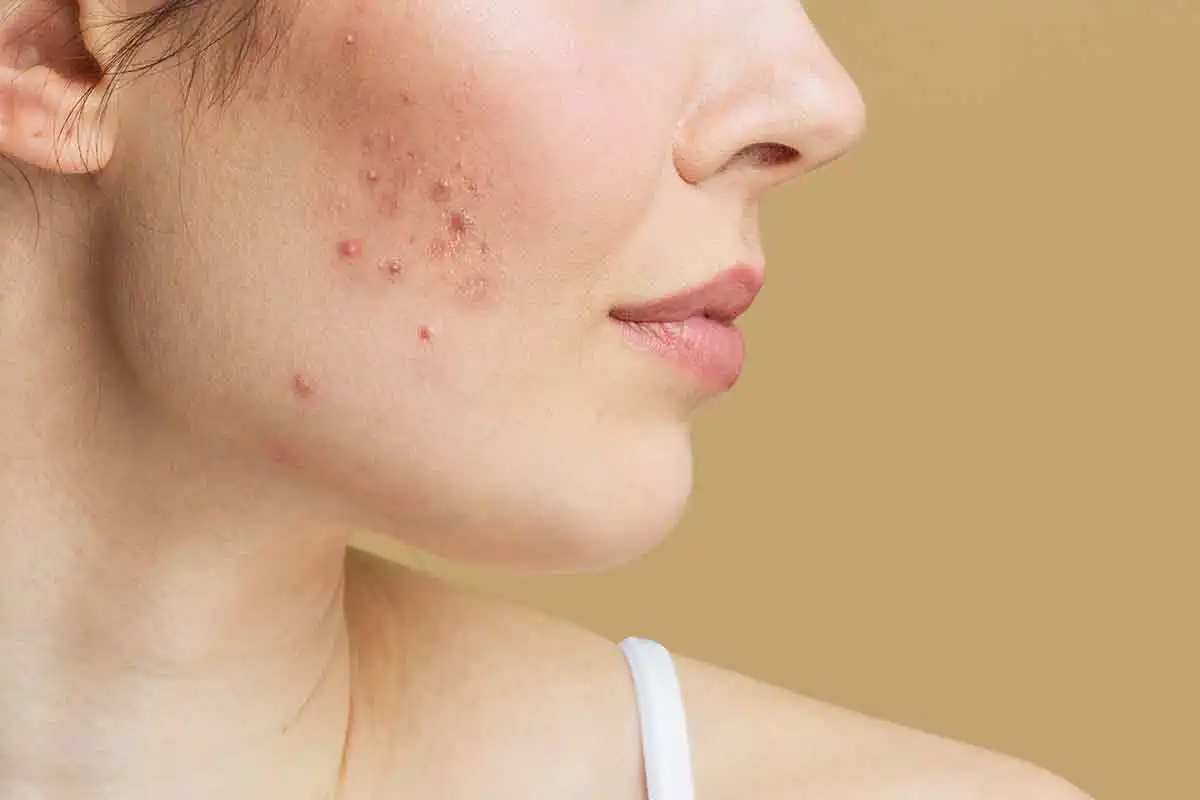 Adult Acne: Causes, Treatment, and Prevention Tips